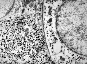 F,44y. | carcinoid - rectum F,44y. | carcinoid - rectum